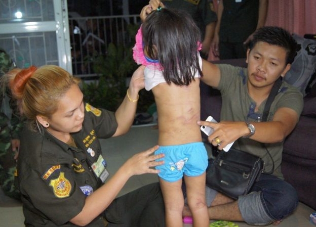 Rescue workers on March 16 show caning marks on a 4-year-old girl’s body who was reportedly beaten by her stepfather and mother in Pathum Thani province. -cropped