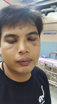 Photo of Kittisak Singto’s injuries posted on Facebook by his sister. Image: Sukanya Singto / Facebook