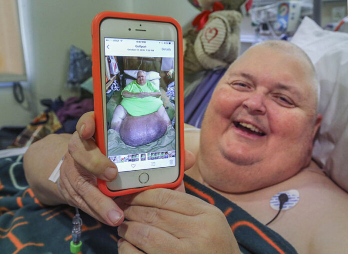 Roger Logan holds up a smartphone Thursday that shows a photo of him with a 130-pound tumor before a surgery to remove it at Bakersfield Memorial Hospital in Bakersfield, California. Photo: Henry A. Barrios / The Bakersfield Californian