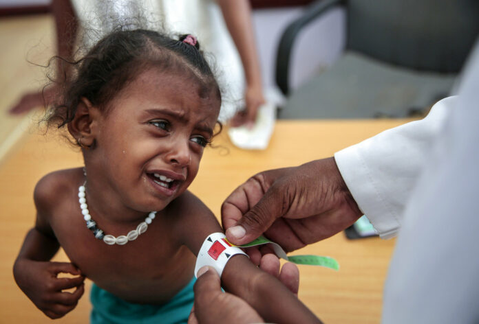 A doctor measures the arm of a malnourished girl in October at the Aslam Health Center, Hajjah, Yemen. Photo: Hani Mohammed / Associated Press