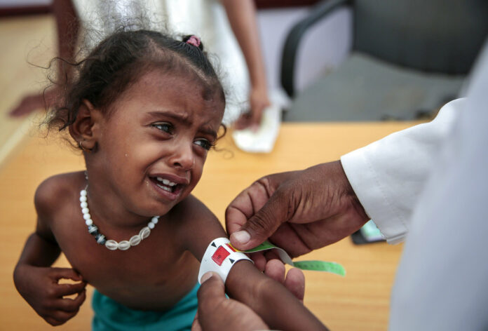 A doctor measures the arm of a malnourished girl in October at the Aslam Health Center, Hajjah, Yemen. Photo: Hani Mohammed / Associated Press A doctor measures the arm of a malnourished girl in October at the Aslam Health Center, Hajjah, Yemen. Photo: Hani Mohammed / Associated Press