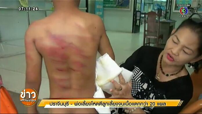 A woman shows wounds on the body of her 7-year-old son allegedly inflicted