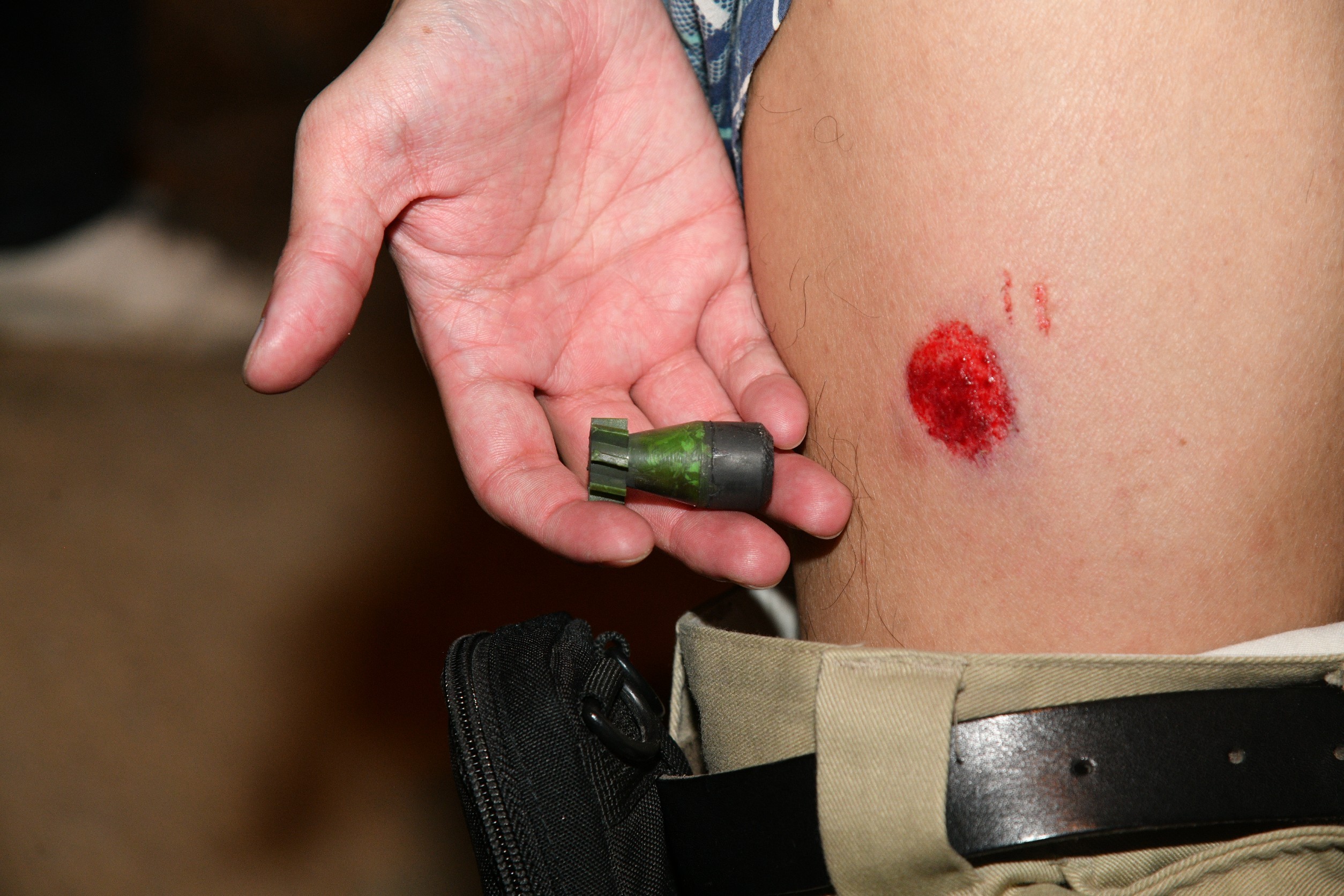 A demonstrator shows a wound caused by a rubber bullet.
