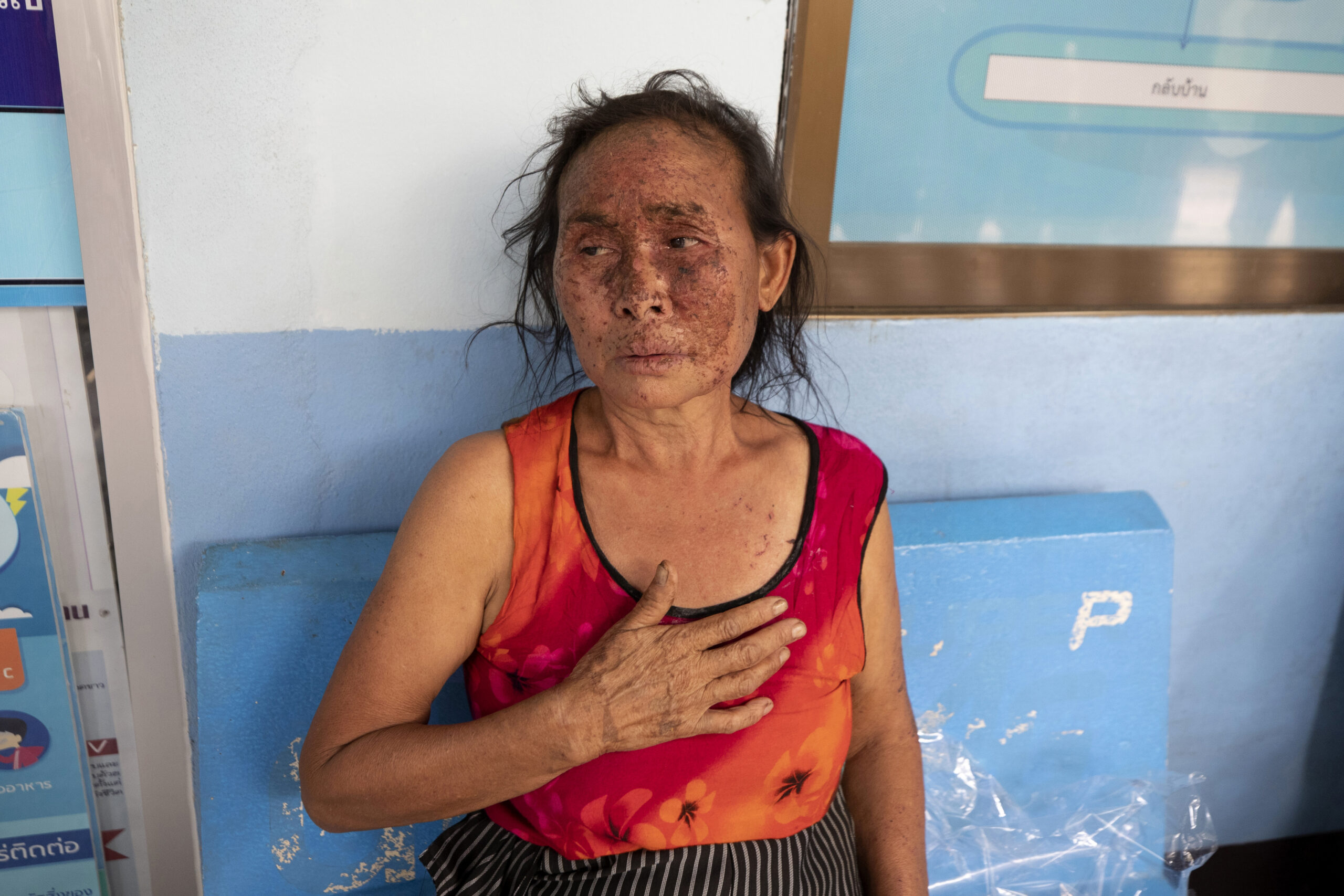 In this Tuesday March 30, 2021, file photo, an injured Karen villager from Myanmar rests at Ban Mae Sam Laep Health Center in Mae Hong Son province, northern Thailand, after they crossed Salawin river on a boat. Photo: Sakchai Lalit / AP File