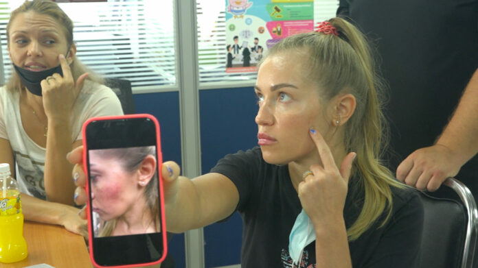 Russian tourist Ekaterina Kuzmenko, 33, shows her bruise after being assaulted by a Thai man on Jan. 1, 2022. Russian tourist Ekaterina Kuzmenko, 33, shows her bruise after being assaulted by a Thai man on Jan. 1, 2022.