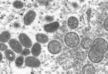 Monkeypox Kills 9 in Congo; First Death in Nigeria in 2022 FILE - This 2003 electron microscope image made available by the Centers for Disease Control and Prevention shows mature, oval-shaped monkeypox virions, left, and spherical immature virions, right, obtained from a sample of human skin associated with the 2003 prairie dog outbreak. Photo: Cynthia S. Goldsmith, Russell Regner / CDC via AP File