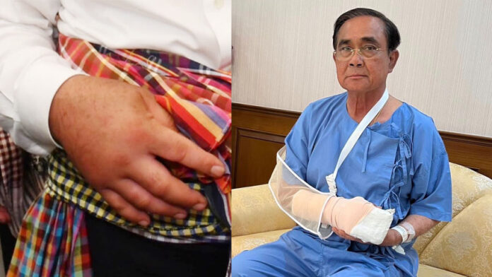 prayut hand6