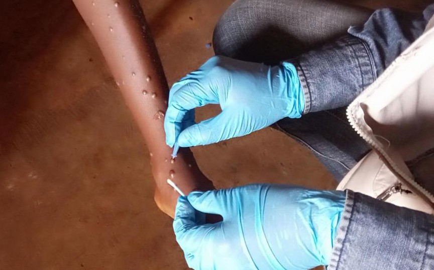 monkeypox un2