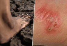 Thai govt warns on melioidosis as cases reach 732 Thai govt warns on melioidosis as cases reach 732