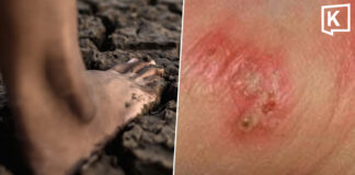Thai govt warns on melioidosis as cases reach 732 Thai govt warns on melioidosis as cases reach 732