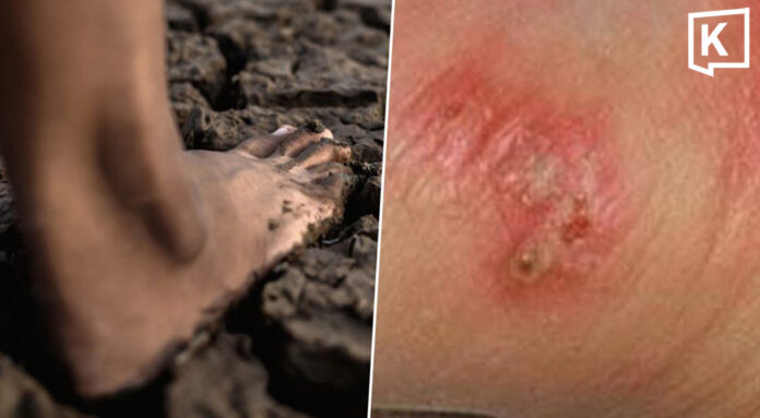 Thai govt warns on melioidosis as cases reach 732