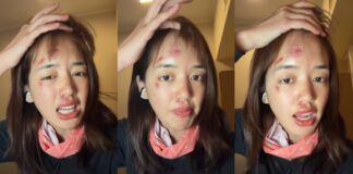 YouTuber Pigkaploy shows bruised face after Antarctic adventure: “Not a filter, real pain”