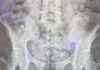 Thai woman caught at Taiwan airport with 72 heroin capsules in her stomach