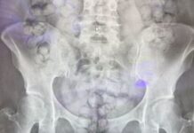 Thai woman caught at Taiwan airport with 72 heroin capsules in her stomach