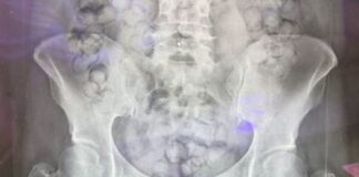 Thai woman caught at Taiwan airport with 72 heroin capsules in her stomach