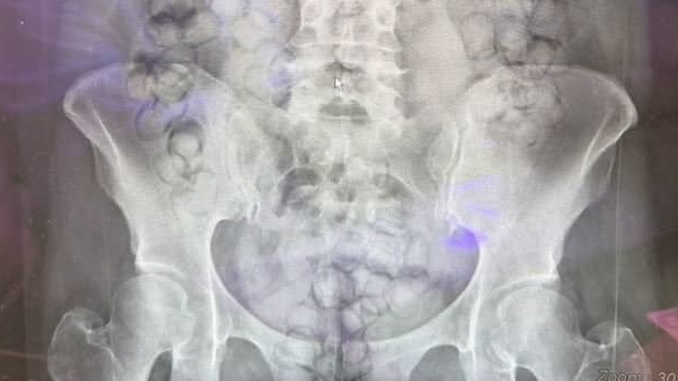Thai woman caught at Taiwan airport with 72 heroin capsules in her stomach
