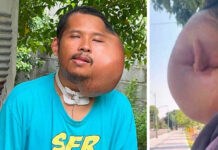Man with severe facial swelling seeks help amid AI claims Man with severe facial swelling seeks help amid AI claims