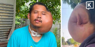 Man with severe facial swelling seeks help amid AI claims Man with severe facial swelling seeks help amid AI claims