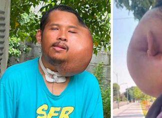 Man with severe facial swelling seeks help amid AI claims Man with severe facial swelling seeks help amid AI claims