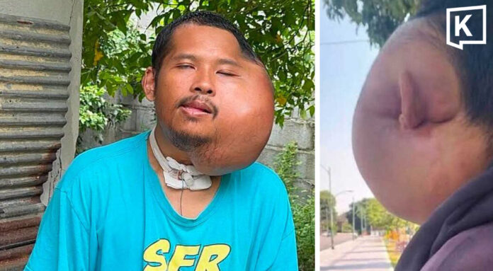 Man with severe facial swelling seeks help amid AI claims Man with severe facial swelling seeks help amid AI claims