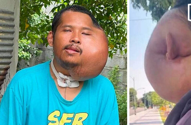 Man with severe facial swelling seeks help amid AI claims Man with severe facial swelling seeks help amid AI claims