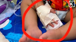 One-year-old loses finger in alleged hospital scissors mishap