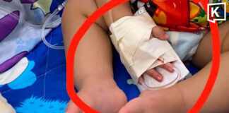 One-year-old loses finger in alleged hospital scissors mishap One-year-old loses finger in alleged hospital scissors mishap