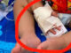 One-year-old loses finger in alleged hospital scissors mishap One-year-old loses finger in alleged hospital scissors mishap