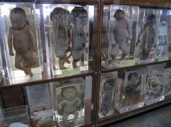 Deformed foetuses are preserved and displayed at Siriraj Medical Museum, Bangkok, Thailand, 17 July 2014. An arrest warrant has been issued for an American man in Thailand who tried to send body parts to the US, officials said Tuesday. Photo: Bill Bredesen/dpa