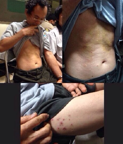 Sansern Sriounruen shows alleged torture that he claims was from his time in military custody. Photo: Thai Lawyers for Human Rights group.